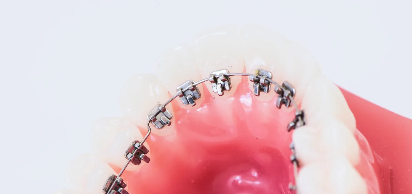 Orthodontiste adulte Puteaux 92800