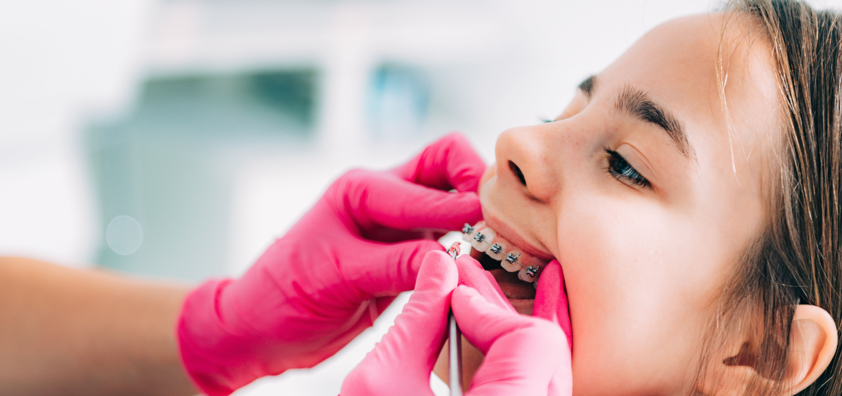 orthodontie adolescent multi attaches puteaux nanterre Orthodontie adolescent wongeczowski